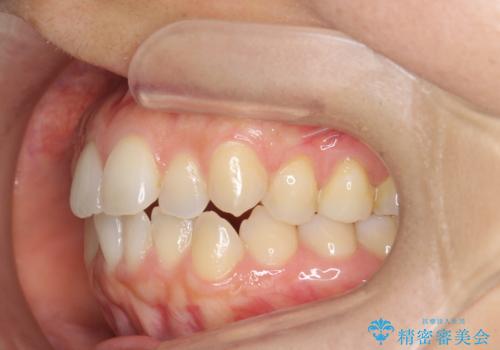 前歯のがたつきをしっかり治すマウスピース矯正の治療前