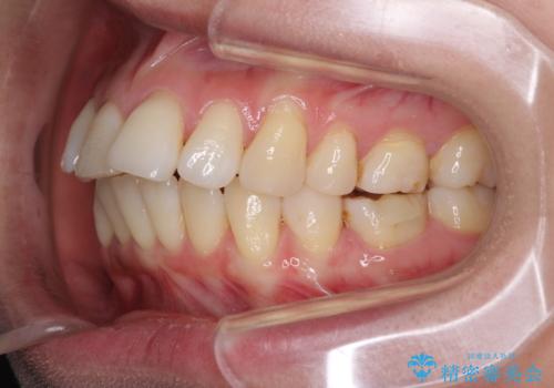 後戻りで突出した口元を引っ込めたい インビザライン矯正治療の治療前