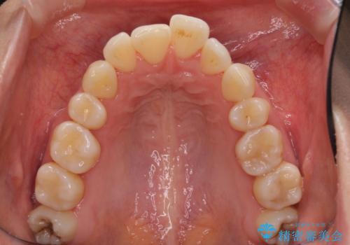 後戻りで突出した口元を引っ込めたい インビザライン矯正治療の治療前