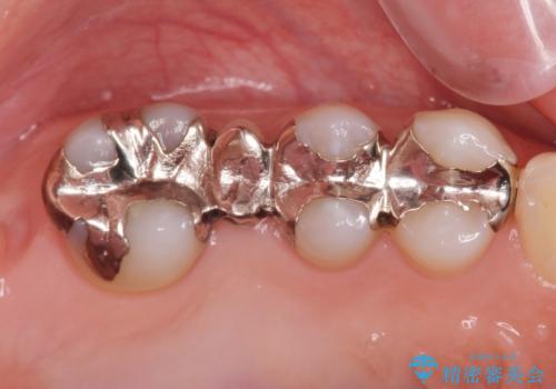 銀の詰め物を白くしたい。の症例 治療前