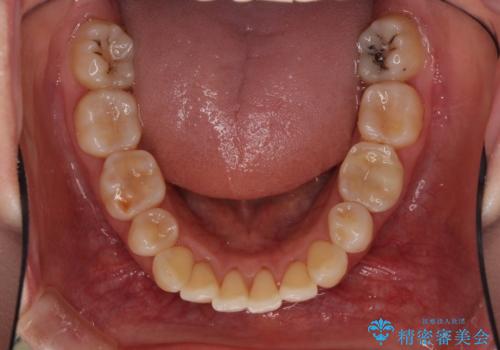 後戻りで突出した口元を引っ込めたい インビザライン矯正治療の治療前
