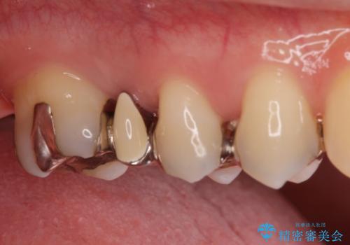 銀の詰め物を白くしたい。の治療前