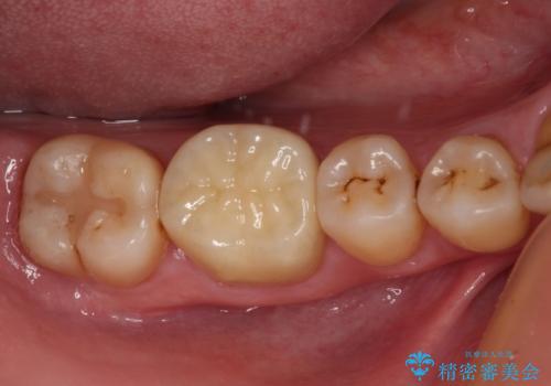 口を開けたときに目立つ銀歯 オールセラミック治療の治療後