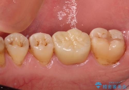 口を開けたときに目立つ銀歯 オールセラミック治療の治療後