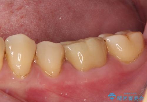 口を開けたときに目立つ銀歯 オールセラミック治療の治療後