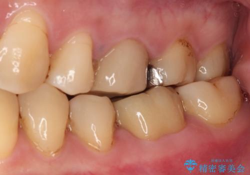 口を開けたときに目立つ銀歯 オールセラミック治療の治療後