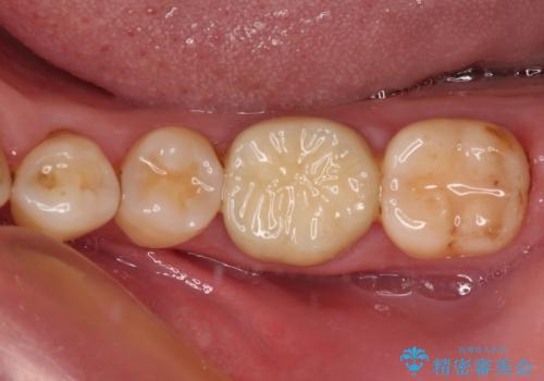 口を開けたときに目立つ銀歯 オールセラミック治療の治療後