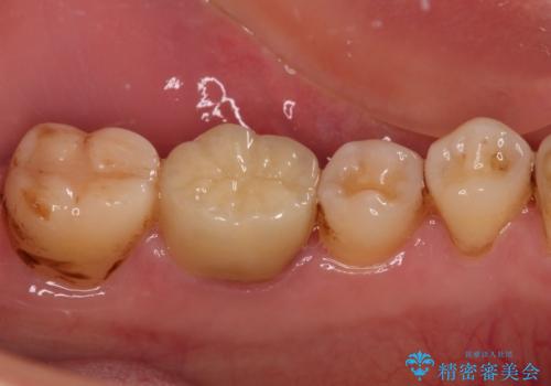 口を開けたときに目立つ銀歯 オールセラミック治療の治療後
