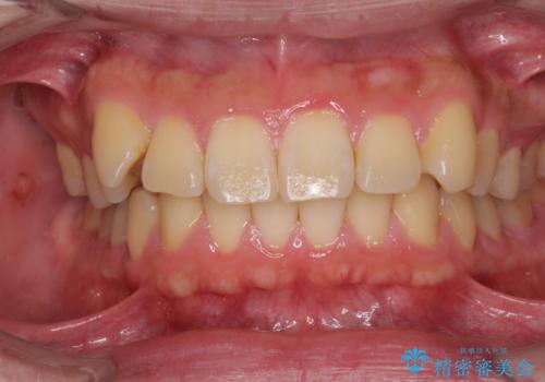 遠方からの通院 インビザライン矯正治療の症例 治療前