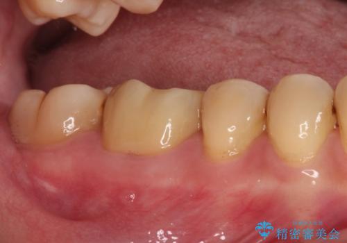 口を開けたときに目立つ銀歯 オールセラミック治療の治療後