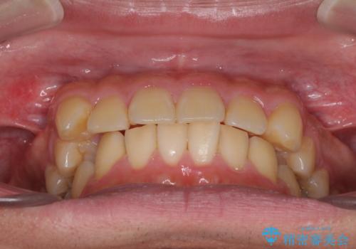 遠方からの通院 インビザライン矯正治療の治療前