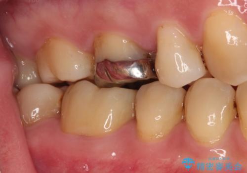 口を開けたときに目立つ銀歯 オールセラミック治療の治療後