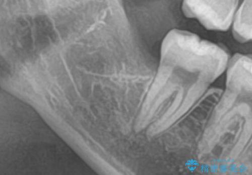 矯正治療前の親知らず抜歯の治療後