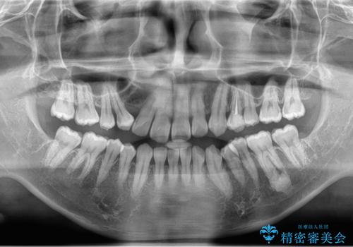 上顎の内側に歯が生えていて気になる。(静脈内鎮静下での抜歯)の治療後