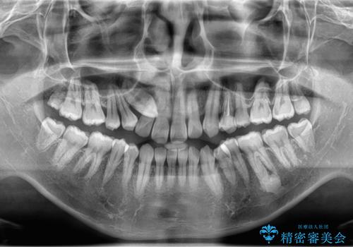 上顎の内側に歯が生えていて気になる。(静脈内鎮静下での抜歯)の治療前
