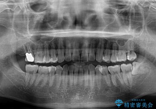 抜歯が必要な奥歯と前歯のデコボコ　インプラント治療とインビザライン矯正治療の治療前
