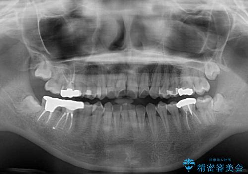デコボコ歯列をきれいに インビザラインによる矯正治療の治療前