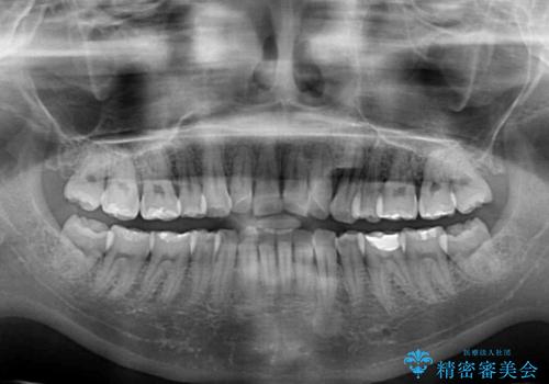 後戻りで突出した口元を引っ込めたい インビザライン矯正治療の治療前