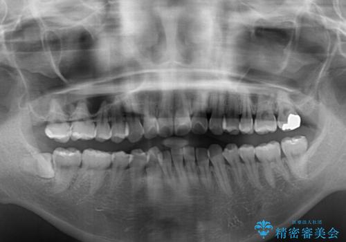 前に出ている前歯を引っ込めたい インビザライン矯正の治療前