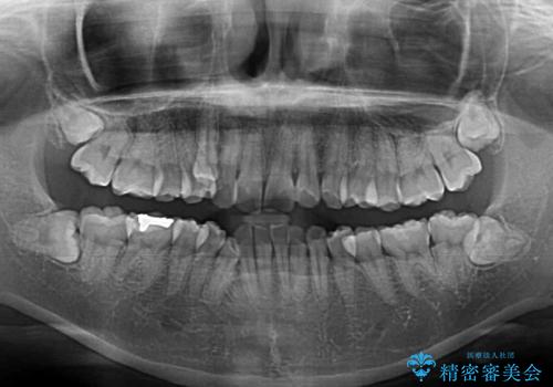 八重歯の抜歯矯正　補助装置とワイヤーを併用したインビザライン矯正治療の治療前