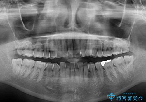 抜歯矯正へ切り替え　表側のワイヤー矯正の治療前