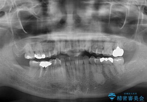 前歯のデコボコとクロスバイト インビザラインによる矯正治療の治療前