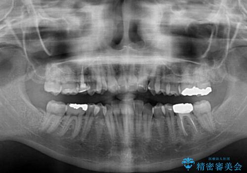 前歯のクロスバイト ギラギラのワイヤー装置で矯正治療の治療前