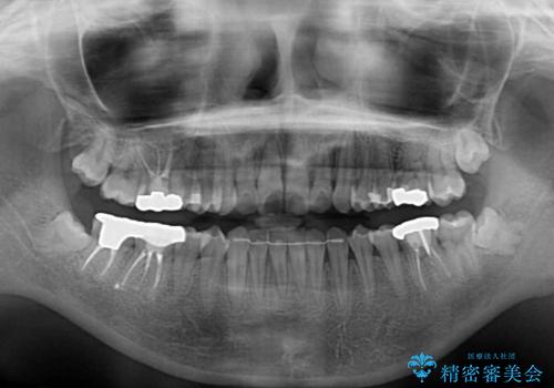 デコボコ歯列をきれいに インビザラインによる矯正治療の治療後