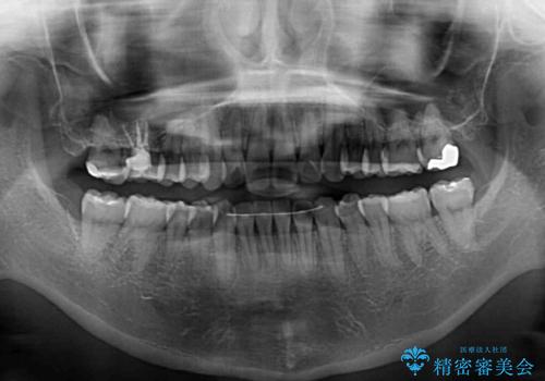 前に出ている前歯を引っ込めたい インビザライン矯正の治療後