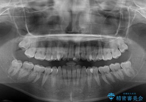 前歯のデコボコと深い咬み合わせ インビザラインできれいに改善の治療前