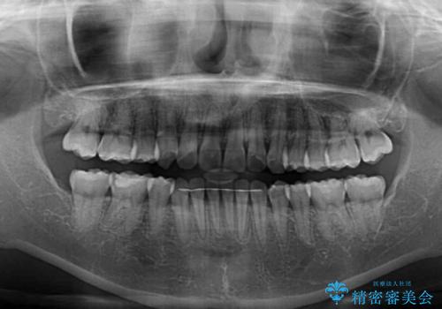 八重歯の抜歯矯正 補助装置とワイヤーを併用したインビザライン矯正治療の治療後