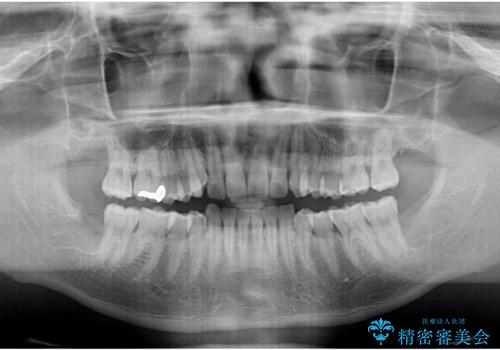 遠方からの通院 インビザライン矯正治療の治療前