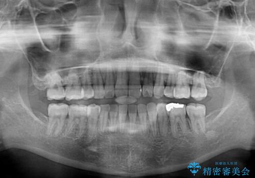 抜歯矯正へ切り替え　表側のワイヤー矯正の治療後