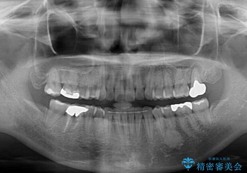 前歯のデコボコとクロスバイト　インビザラインによる矯正治療の治療後