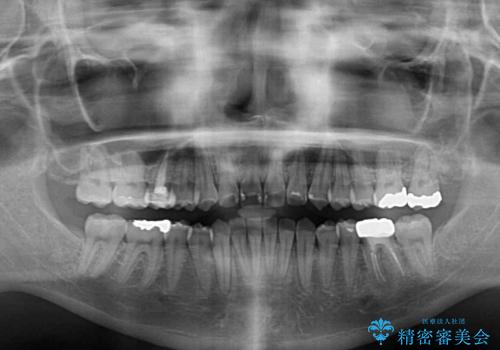 前歯のクロスバイト ギラギラのワイヤー装置で矯正治療の治療後