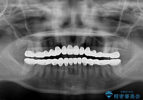 変色している歯をとにかく白く　全顎セラミック治療の治療後
