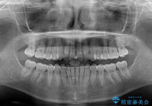 前歯のデコボコと深い咬み合わせ インビザラインできれいに改善の治療後