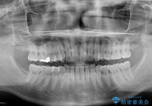 遠方からの通院 インビザライン矯正治療の治療後