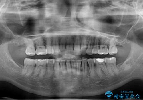 後戻りで突出した口元を引っ込めたい インビザライン矯正治療の治療後