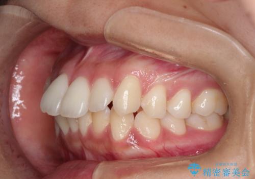 【インビザライン】前歯の凸凹を綺麗にしたいの治療前