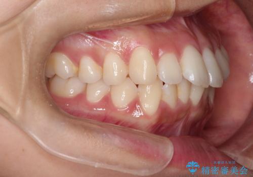 【インビザライン】前歯の凸凹を綺麗にしたいの治療前