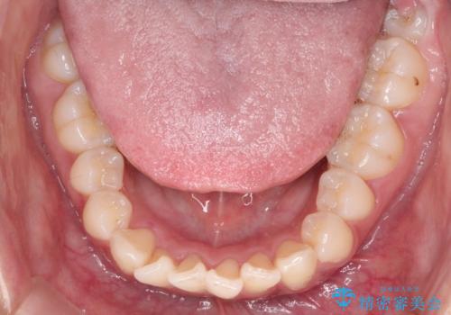 【インビザライン】前歯の凸凹を綺麗にしたいの治療前