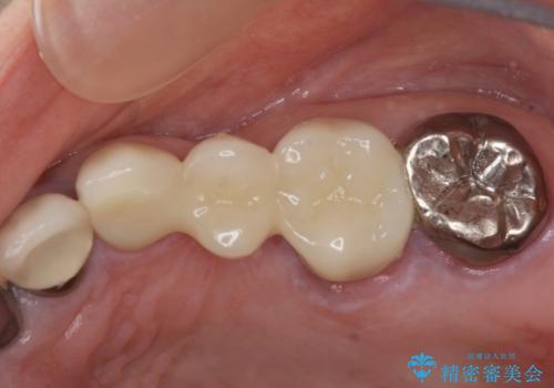 銀歯の見た目を改善、ジルコニア製セラミックブリッジの治療後