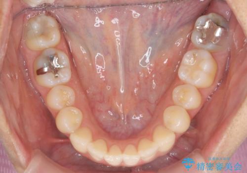 前歯のがたつきをしっかり治すマウスピース矯正の治療後