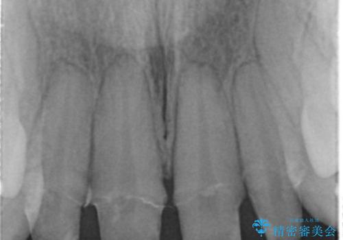 仮歯のまま放置していた前歯をセラミックにの治療前