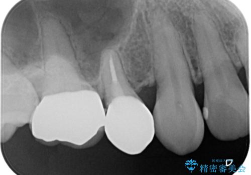物が詰まりやすく歯茎が腫れるの治療後