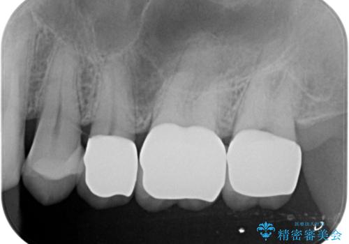 歯の神経を守る、精密な虫歯治療の実践の治療後