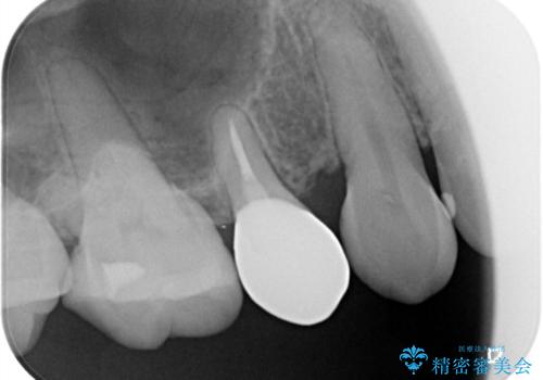 物が詰まりやすく歯茎が腫れるの治療前