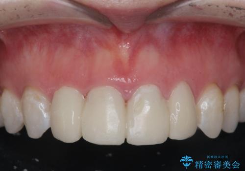 仮歯のまま放置していた前歯をセラミックにの症例 治療前