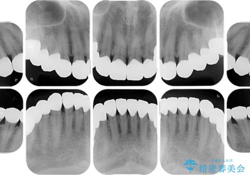 変色している歯をとにかく白く　全顎セラミック治療の治療後